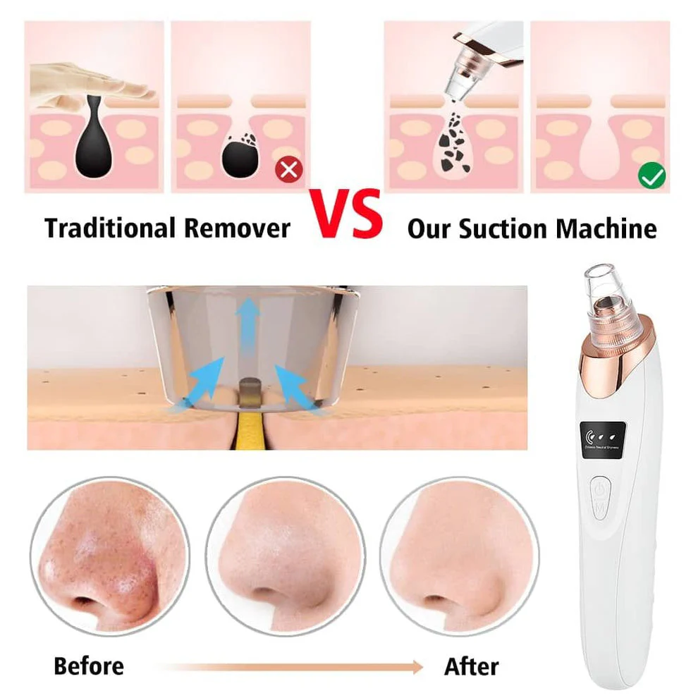 5-in-1 Blackhead Remover Facial Pore